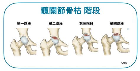 為什麼會骨枯|【01醫務所】髖關節骨枯病人難自覺患病 高危人士需。